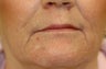 Juvederm