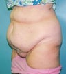 62 year old Female underwent tummy tuck 