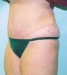 62 year old Female underwent tummy tuck 