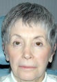 Laser resurfacing blepharoplasty, and ptosis repair