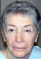 Laser resurfacing blepharoplasty, and ptosis repair