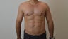 VASER Hi-Definition Liposuction of Abdomen and Flanks