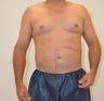 VASER Hi-Definition Liposuction of Abdomen and Flanks