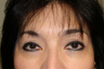 Eyelid Surgery