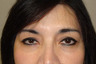 Eyelid Surgery