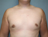 Male Breast Reduction 