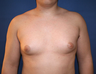 Male Breast Reduction 