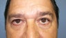 Eyelid Surgery