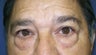 Eyelid Surgery