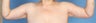 Brachioplasty