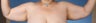 Brachioplasty