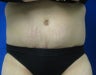 Tummy Tuck and Liposuction