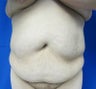 Tummy Tuck and Liposuction