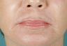CO2 Laser Skin Resurfacing