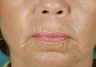 CO2 Laser Skin Resurfacing