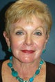 Chemical Peel