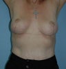 Breast Lift