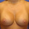 Breast Augmentation