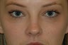Restylane