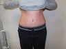 Tummy Tuck