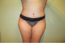Tummy Tuck