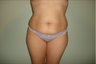 Tummy Tuck