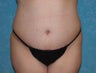 Tummy Tuck