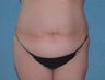 Tummy Tuck