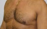 Male Breast Reduction 