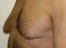 Male Breast Reduction 