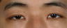 Asian Blepharoplasty