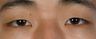 Asian Blepharoplasty
