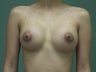 Breast Augmentation