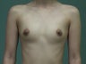 Breast Augmentation