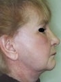 Female patient who underwent laser surgery 
