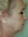 Female patient who underwent laser surgery 