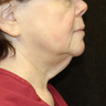 Neck Lift