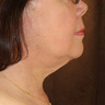 Neck Lift