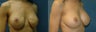 Breast Implant Revision