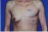 45 year old left breast reconstruction with implant