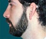 Male Chin Augmentation