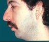 Male Chin Augmentation
