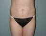 Female patient who underwent a tummy tuck 
