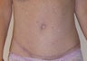 Tummy Tuck