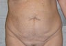 Tummy Tuck