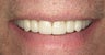 Smile Makeover