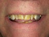 Smile Makeover