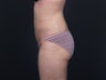 Liposuction Abdomen, Flanks, Inner & Outer Thighs