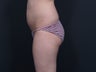 Liposuction Abdomen, Flanks, Inner & Outer Thighs