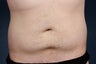 CoolSculpting